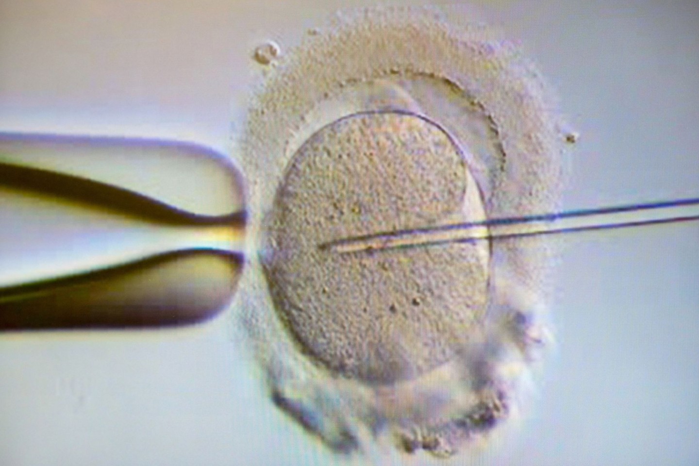 Ein Monitor zeigt eine Intrazytoplasmatische Spermieninjektion (Icsi). Bei der Behandlung wird einer Eizelle ein Spermium injiziert.